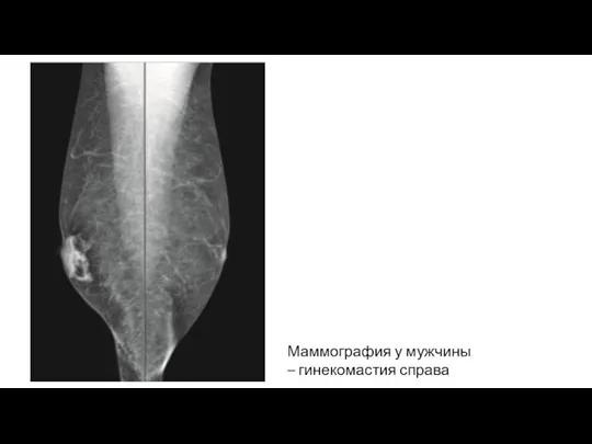 Маммография у мужчины – гинекомастия справа