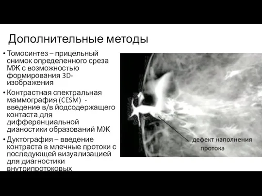 Дополнительные методы Томосинтез – прицельный снимок определенного среза МЖ с возможностью формирования