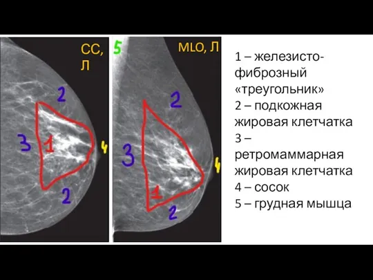 1 – железисто-фиброзный «треугольник» 2 – подкожная жировая клетчатка 3 – ретромаммарная
