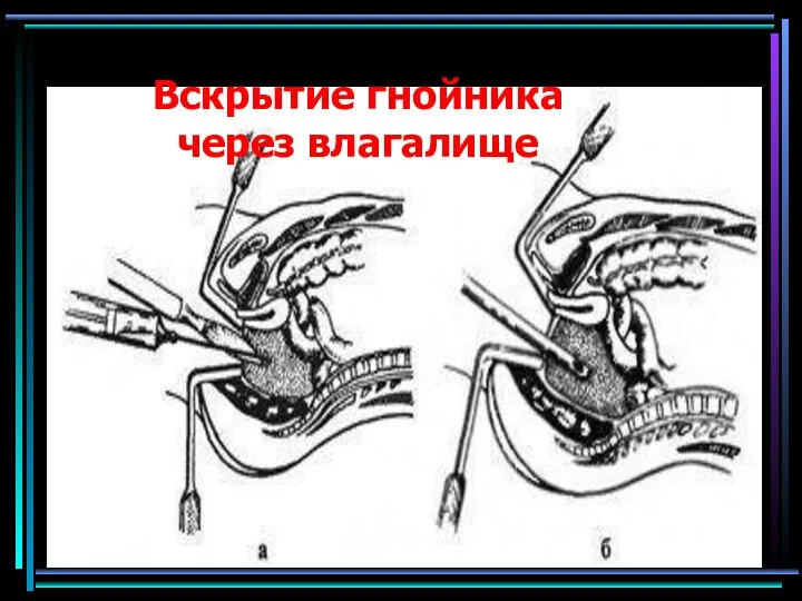 Вскрытие гнойника через влагалище