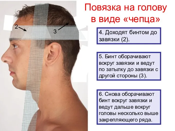 Повязка на голову в виде «чепца» 4. Доходят бинтом до завязки (2).