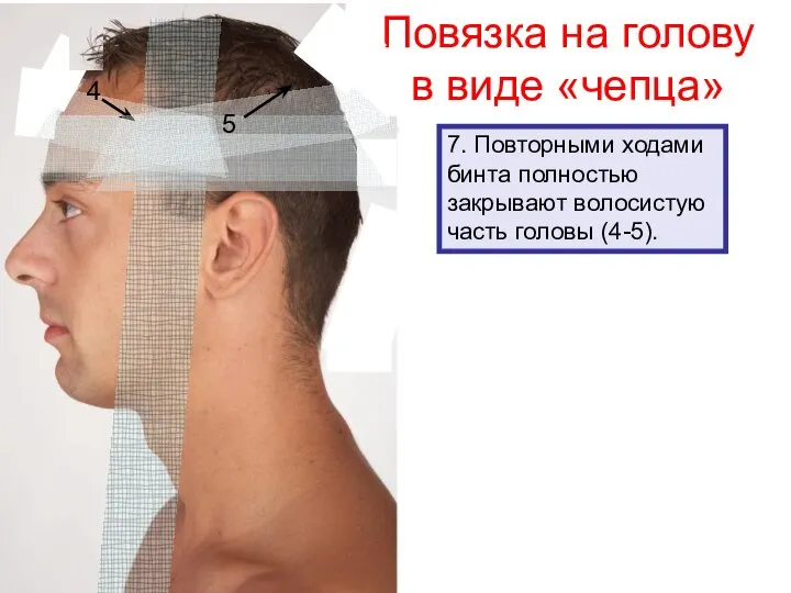 Повязка на голову в виде «чепца» 7. Повторными ходами бинта полностью закрывают