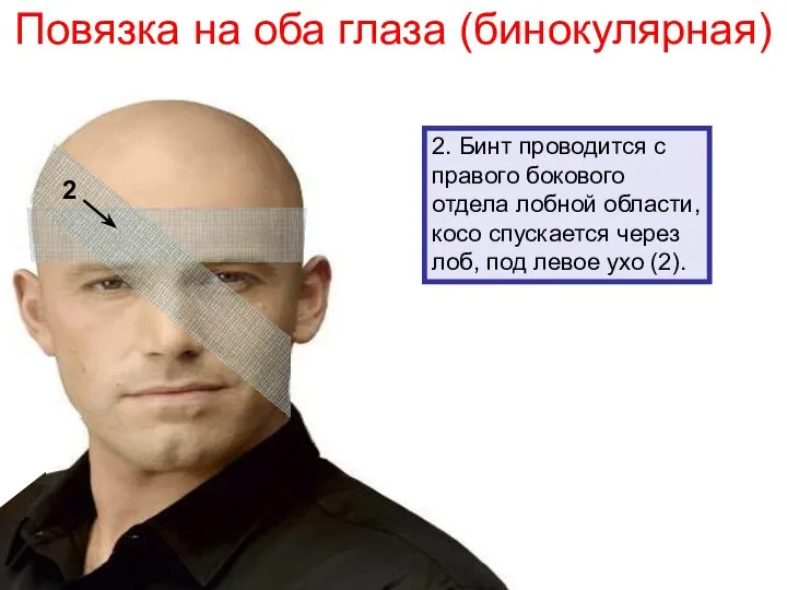 2. Бинт проводится с правого бокового отдела лобной области, косо спускается через