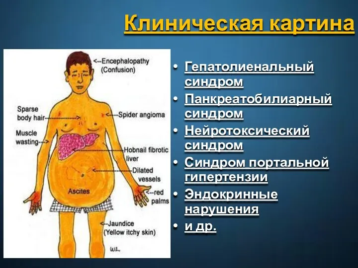 Клиническая картина Гепатолиенальный синдром Панкреатобилиарный синдром Нейротоксический синдром Синдром портальной гипертензии Эндокринные нарушения и др.