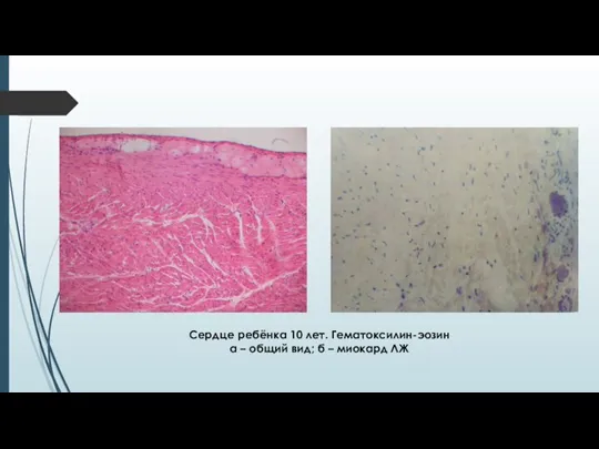 Сердце ребёнка 10 лет. Гематоксилин-эозин а – общий вид; б – миокард ЛЖ