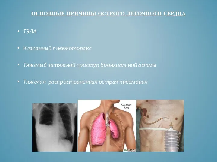 ОСНОВНЫЕ ПРИЧИНЫ ОСТРОГО ЛЕГОЧНОГО СЕРДЦА ТЭЛА Клапанный пневмоторакс Тяжелый затяжной приступ бронхиальной