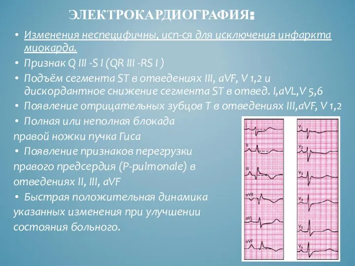 ЭЛЕКТРОКАРДИОГРАФИЯ: Изменения неспецифичны, исп-ся для исключения инфаркта миокарда. Признак Q III -S