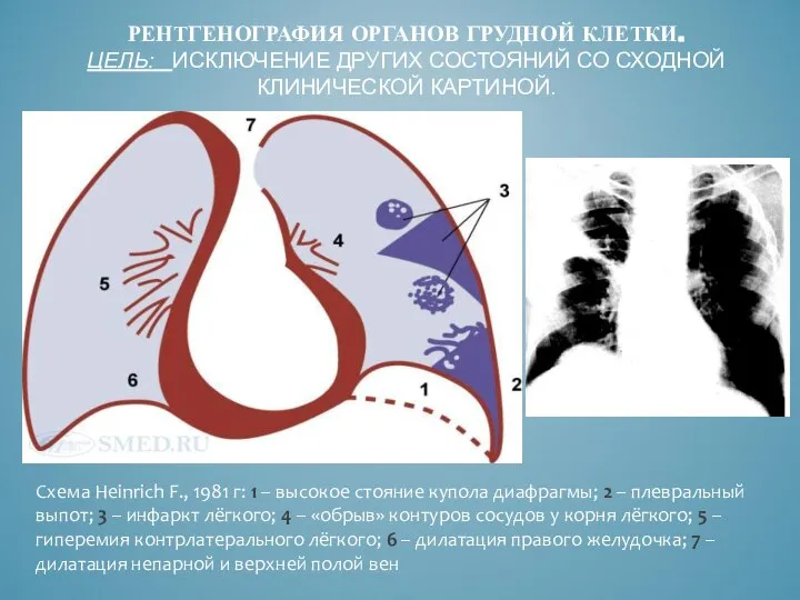 РЕНТГЕНОГРАФИЯ ОРГАНОВ ГРУДНОЙ КЛЕТКИ. ЦЕЛЬ: ИСКЛЮЧЕНИЕ ДРУГИХ СОСТОЯНИЙ СО СХОДНОЙ КЛИНИЧЕСКОЙ КАРТИНОЙ.