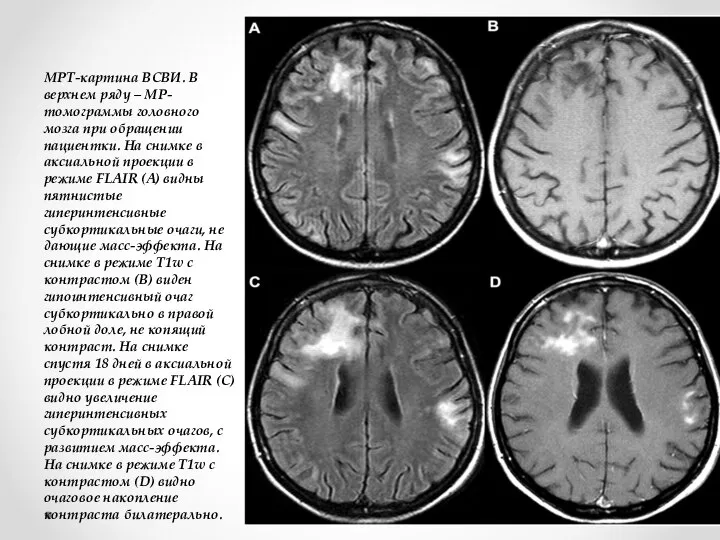 МРТ-картина ВСВИ. В верхнем ряду – МР-томограммы головного мозга при обращении пациентки.