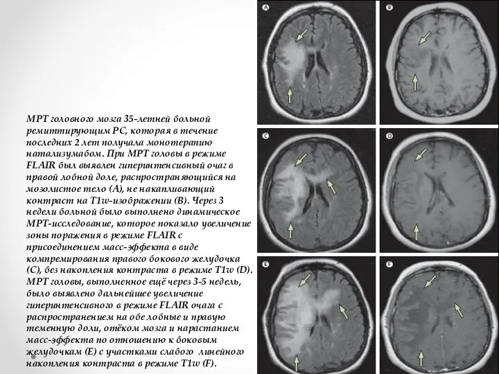 МРТ головного мозга 35-летней больной ремиттирующим РС, которая в течение последних 2