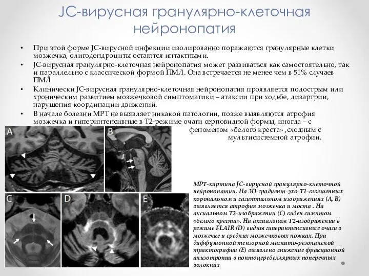 JC-вирусная гранулярно-клеточная нейронопатия При этой форме JC-вирусной инфекции изолированно поражаются гранулярные клетки