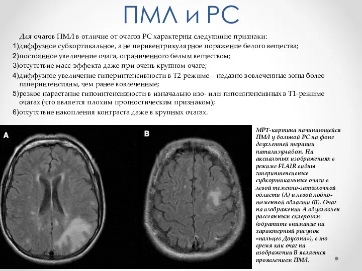 ПМЛ и РС Для очагов ПМЛ в отличие от очагов РС характерны