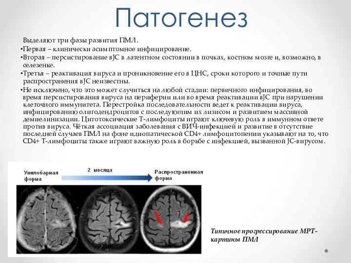 Патогенез Выделяют три фазы развития ПМЛ. Первая – клинически асимптомное инфицирование. Вторая