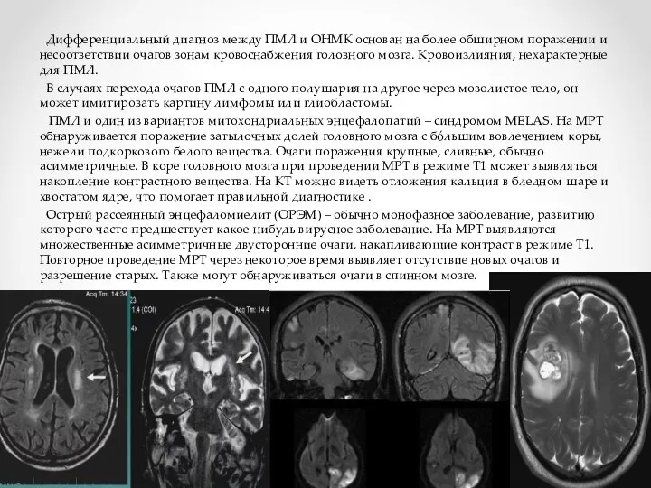 Дифференциальный диагноз между ПМЛ и ОНМК основан на более обширном поражении и