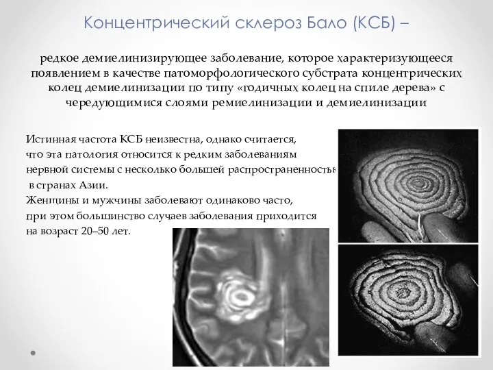 Концентрический склероз Бало (КСБ) – редкое демиелинизирующее заболевание, которое характеризующееся появлением в