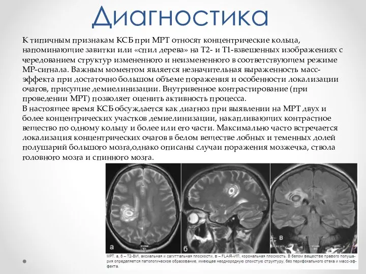 Диагностика К типичным признакам КСБ при MPT относят концентрические кольца, напоминающие завитки