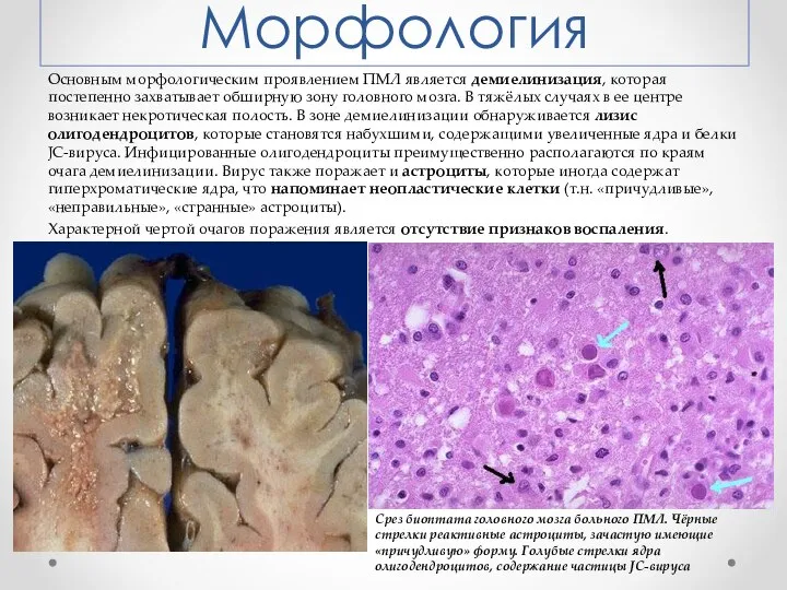 Морфология Основным морфологическим проявлением ПМЛ является демиелинизация, которая постепенно захватывает обширную зону