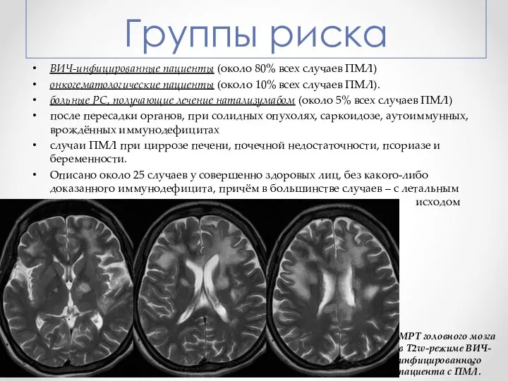 Группы риска ВИЧ-инфицированные пациенты (около 80% всех случаев ПМЛ) онкогематологические пациенты (около