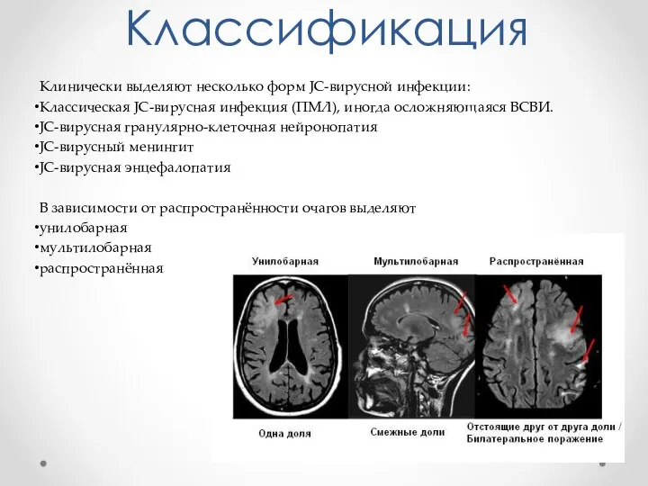 Классификация Клинически выделяют несколько форм JC-вирусной инфекции: Классическая JC-вирусная инфекция (ПМЛ), иногда