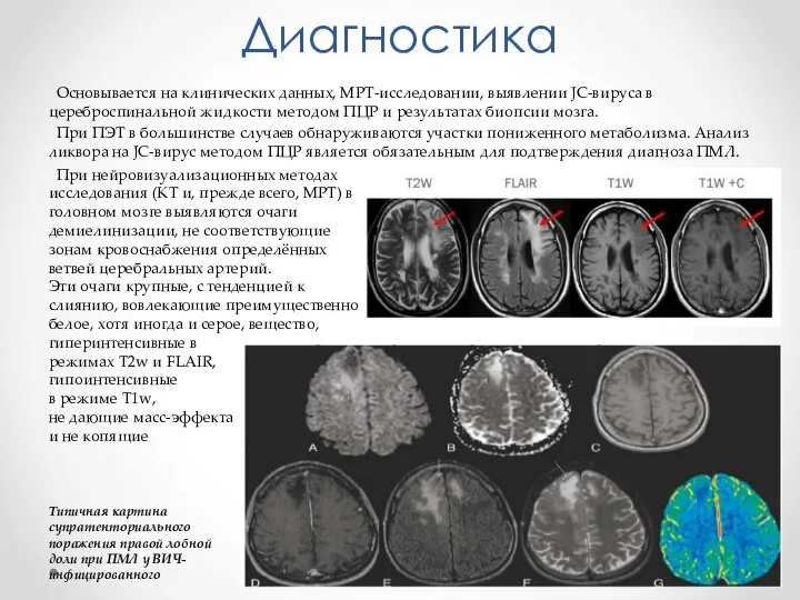 Диагностика Основывается на клинических данных, МРТ-исследовании, выявлении JC-вируса в цереброспинальной жидкости методом