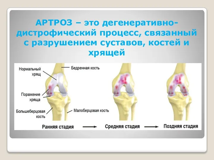 АРТРОЗ – это дегенеративно-дистрофический процесс, связанный с разрушением суставов, костей и хрящей