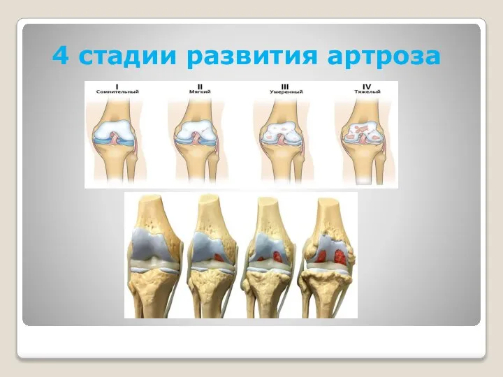 4 стадии развития артроза