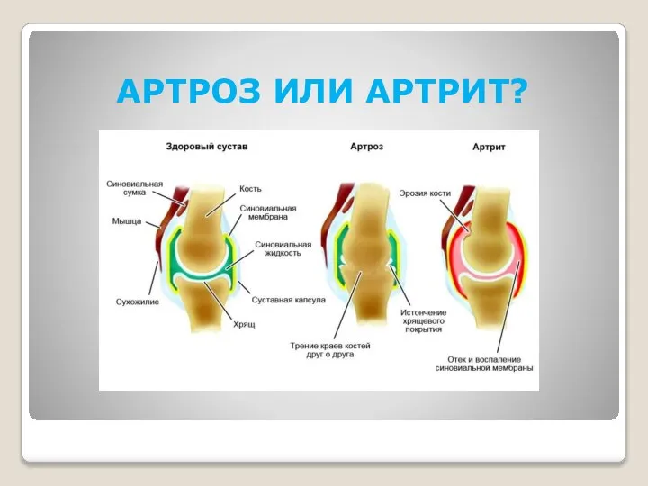 АРТРОЗ ИЛИ АРТРИТ?