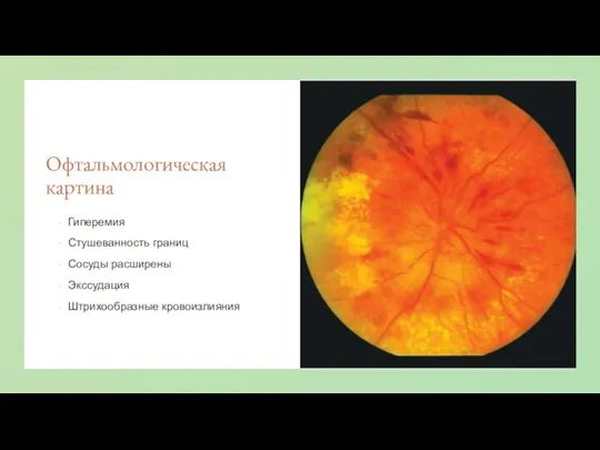 Офтальмологическая картина Гиперемия Стушеванность границ Сосуды расширены Экссудация Штрихообразные кровоизлияния