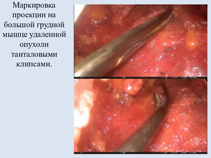 Маркировка проекции на большой грудной мышце удаленной опухоли танталовыми клипсами.