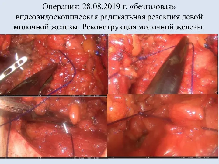 Операция: 28.08.2019 г. «безгазовая» видеоэндоскопическая радикальная резекция левой молочной железы. Реконструкция молочной железы.