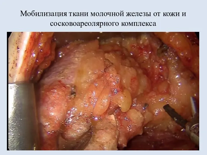 Мобилизация ткани молочной железы от кожи и сосковоареолярного комплекса