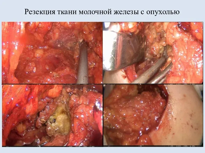 Резекция ткани молочной железы с опухолью