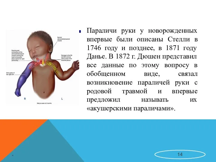 Параличи руки у новорожденных впервые были описаны Стелли в 1746 году и