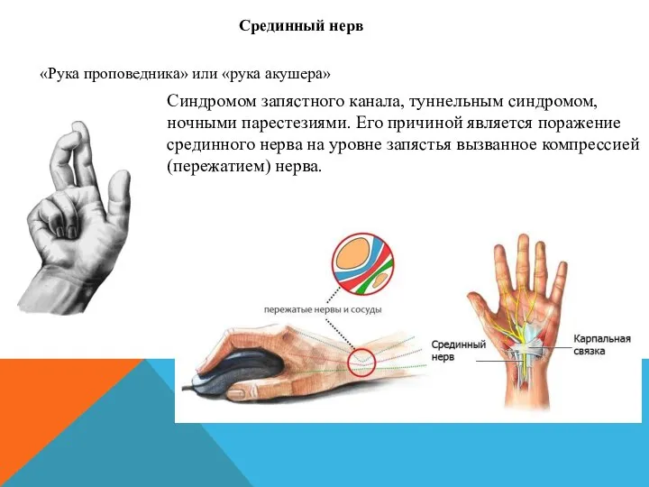 «Рука проповедника» или «рука акушера» Срединный нерв Синдромом запястного канала, туннельным синдромом,