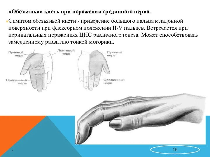 «Обезьянья» кисть при поражении срединного нерва. Симптом обезьяньей кисти - приведение большого