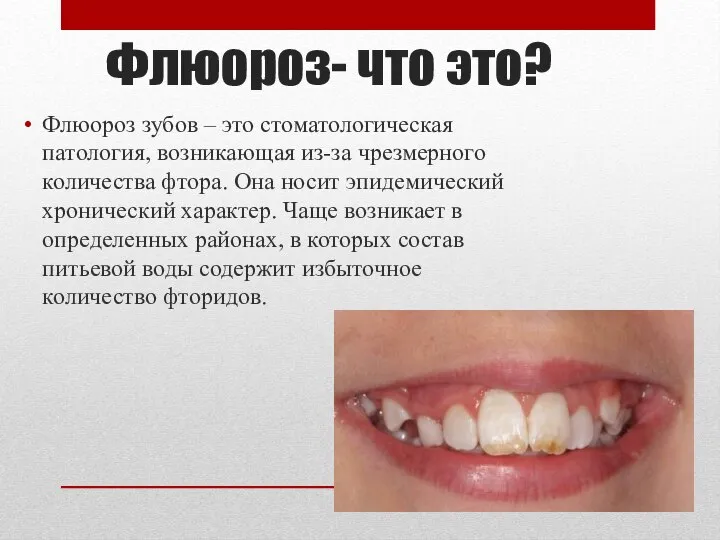 Флюороз- что это? Флюороз зубов – это стоматологическая патология, возникающая из-за чрезмерного