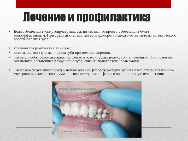 Лечение и профилактика Если заболевание уже распространилось на дентин, то просто отбеливание