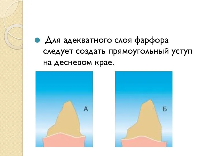 Для адекватного слоя фарфора следует создать прямоугольный уступ на десневом крае.