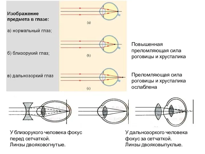 Повышенная преломляющая сила роговицы и хрусталика Преломляющая сила роговицы и хрусталика ослаблена