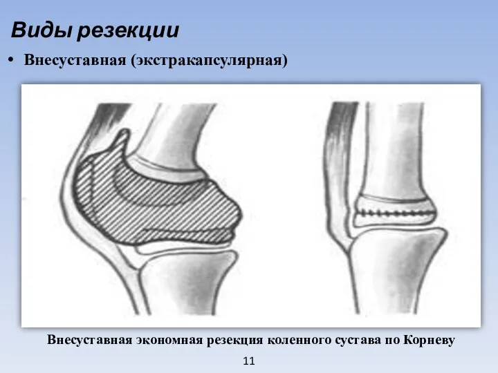 11 Виды резекции Внесуставная (экстракапсулярная)