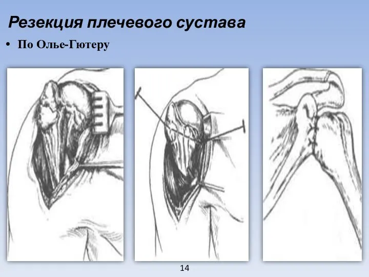 14 Резекция плечевого сустава По Олье-Гютеру