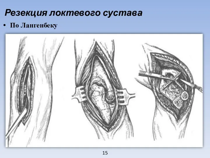 15 Резекция локтевого сустава По Лангенбеку