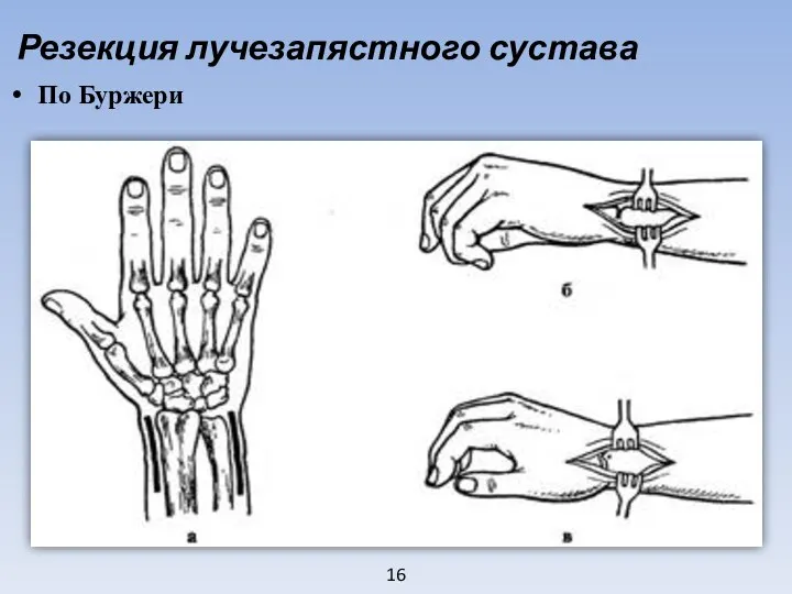 16 Резекция лучезапястного сустава По Буржери