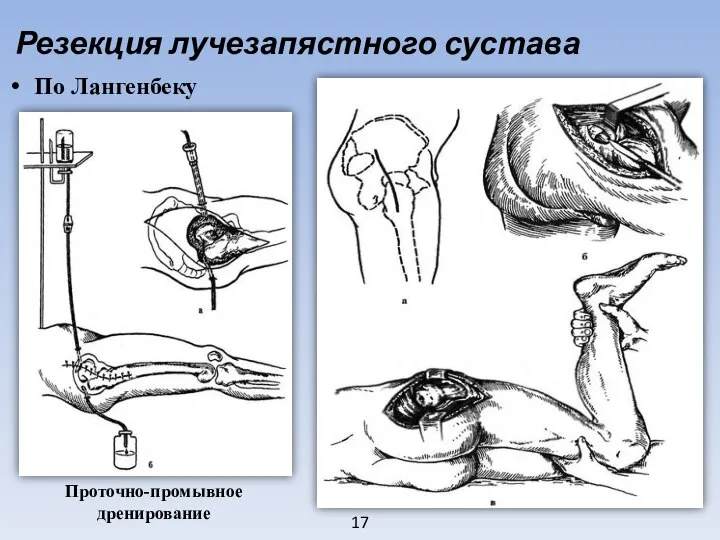 17 Резекция лучезапястного сустава По Лангенбеку Проточно-промывное дренирование