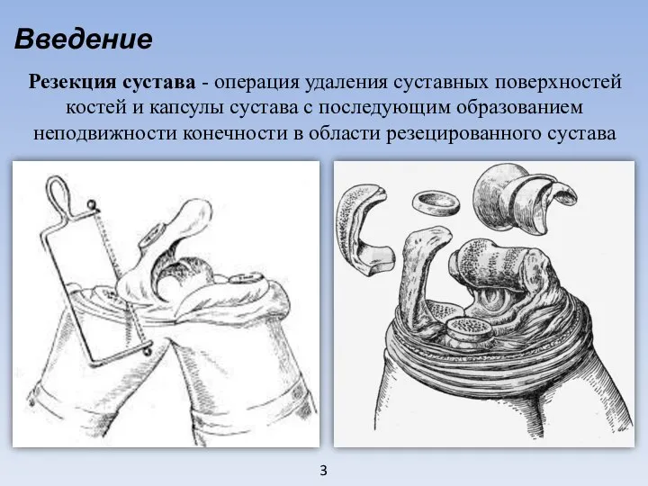 3 Введение Резекция сустава - операция удаления суставных поверхностей костей и капсулы