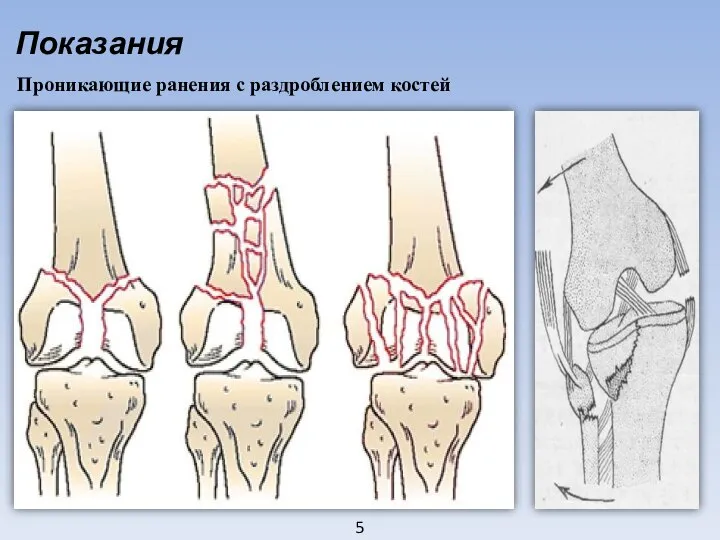 5 Показания Проникающие ранения с раздроблением костей