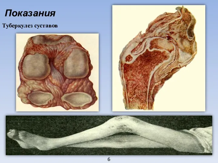 6 Показания Туберкулез суставов