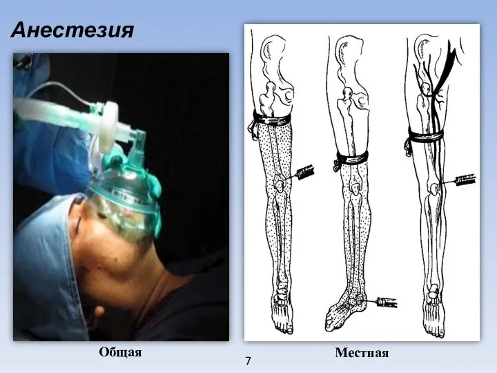 7 Анестезия