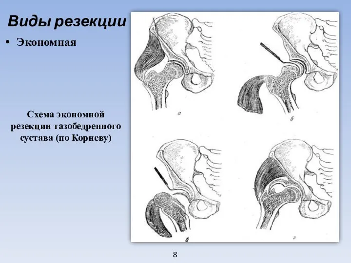 8 Виды резекции Экономная Схема экономной резекции тазобедренного сустава (по Корневу)