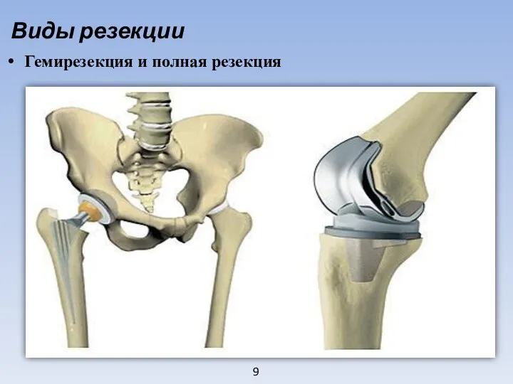 9 Виды резекции Гемирезекция и полная резекция